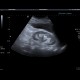 Renal obstruction: US - Ultrasound